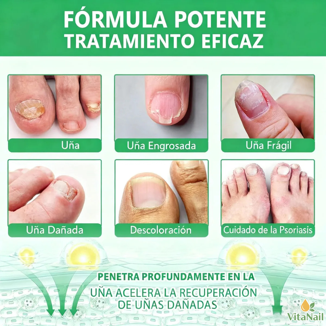 VITANAIL | TRATAMIENTO ANTI HONGOS 7 DÍAS 100% NATURAL OFERTA 2X1