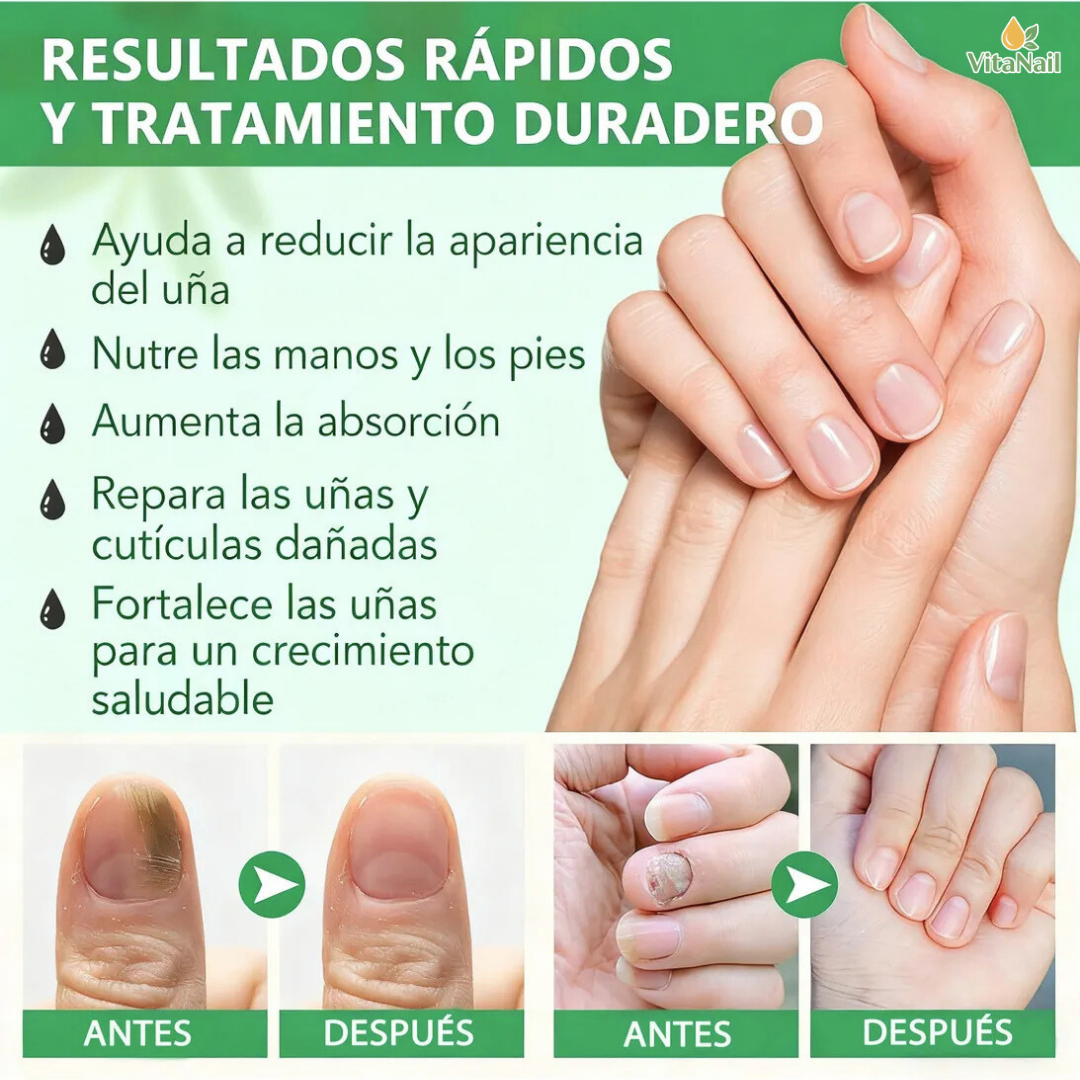 VITANAIL | TRATAMIENTO ANTI HONGOS 7 DÍAS 100% NATURAL OFERTA 2X1