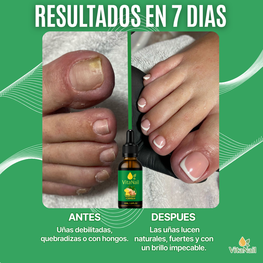 VITANAIL | TRATAMIENTO ANTI HONGOS 7 DÍAS 100% NATURAL OFERTA 2X1