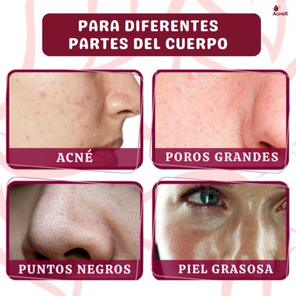 ACNEX | TRATAMIENTO ANTI ACNÉ 7 DÍAS 100% COMPROBADO OFERTA 2X1