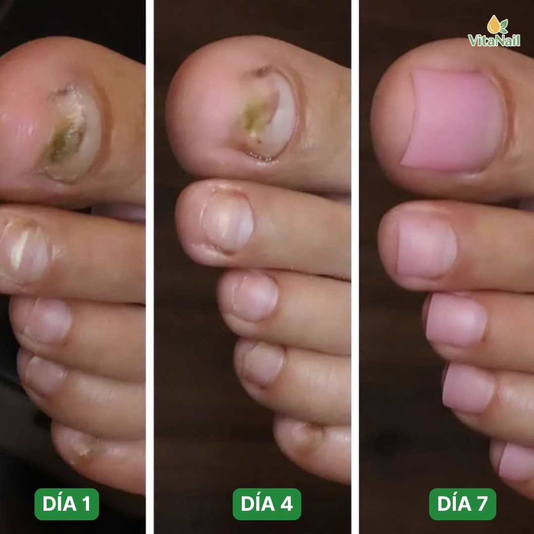 VITANAIL | TRATAMIENTO ANTI HONGOS 7 DÍAS 100% NATURAL OFERTA 2X1