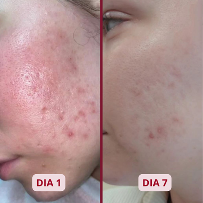 ACNEX | TRATAMIENTO ANTI ACNÉ 7 DÍAS 100% COMPROBADO OFERTA 2X1