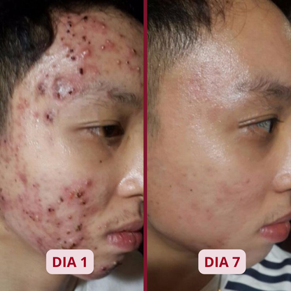 ACNEX | TRATAMIENTO ANTI ACNÉ 7 DÍAS 100% COMPROBADO OFERTA 2X1